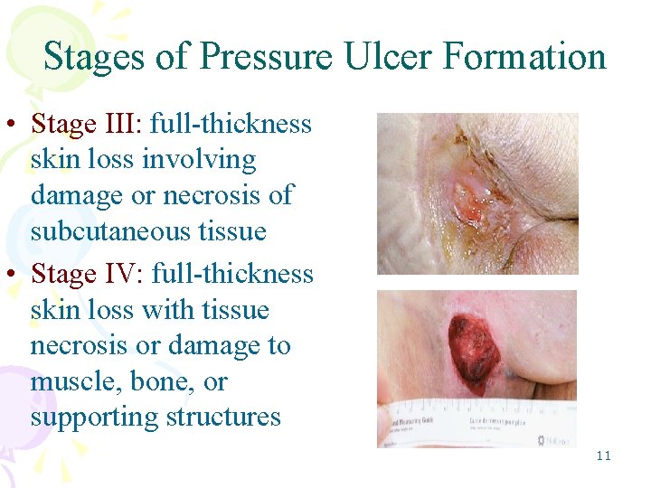 Stages of Pressure Ulcer Formation • Stage III: full-thickness skin loss involving damage or