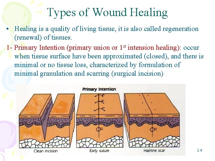 Types of Wound Healing • Healing is a quality of living tissue, it is