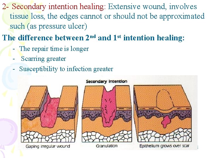 2 - Secondary intention healing: Extensive wound, involves tissue loss, the edges cannot or