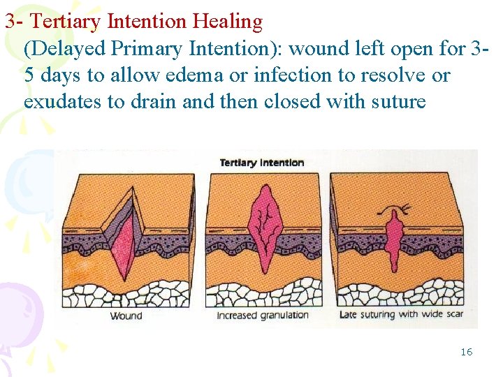 3 - Tertiary Intention Healing (Delayed Primary Intention): wound left open for 35 days