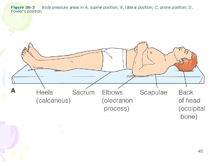 Figure 36 -3 Body pressure areas in A, supine position; B, lateral position; C,