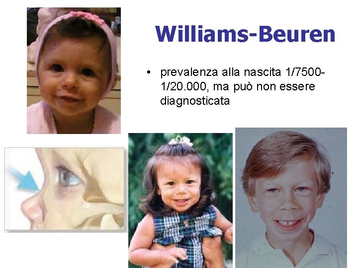 Williams-Beuren • prevalenza alla nascita 1/75001/20. 000, ma può non essere diagnosticata 