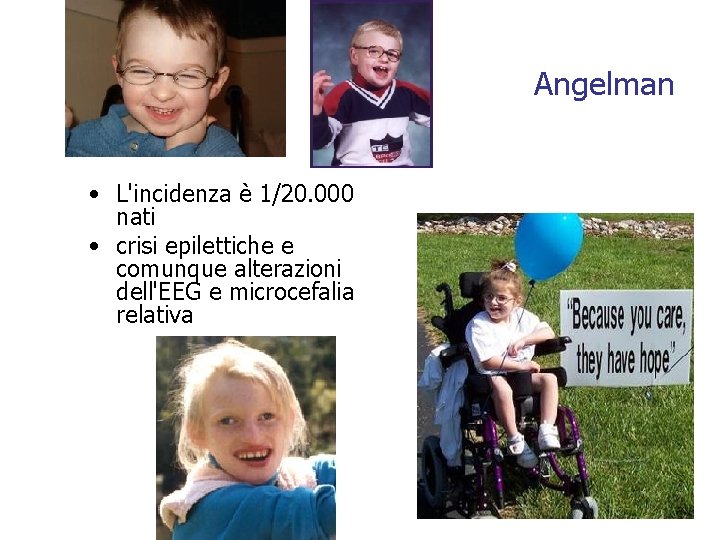 Angelman • L'incidenza è 1/20. 000 nati • crisi epilettiche e comunque alterazioni dell'EEG