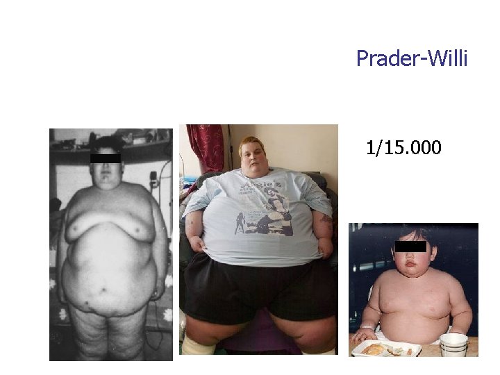 Prader-Willi 1/15. 000 