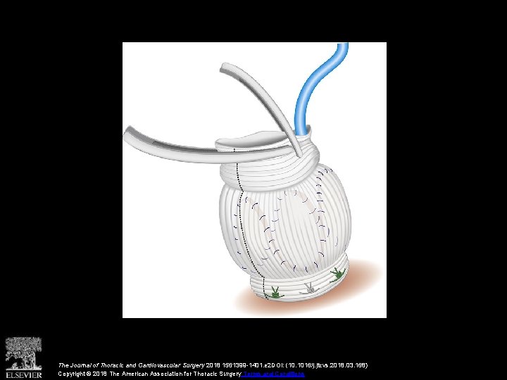 The Journal of Thoracic and Cardiovascular Surgery 2018 1561399 -1401. e 2 DOI: (10.