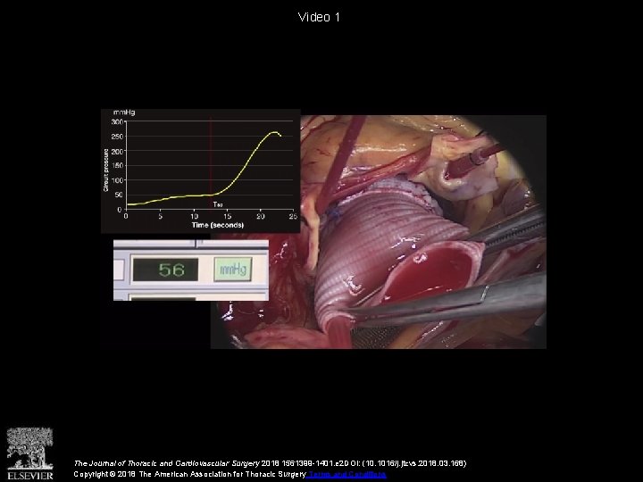 Video 1 The Journal of Thoracic and Cardiovascular Surgery 2018 1561399 -1401. e 2