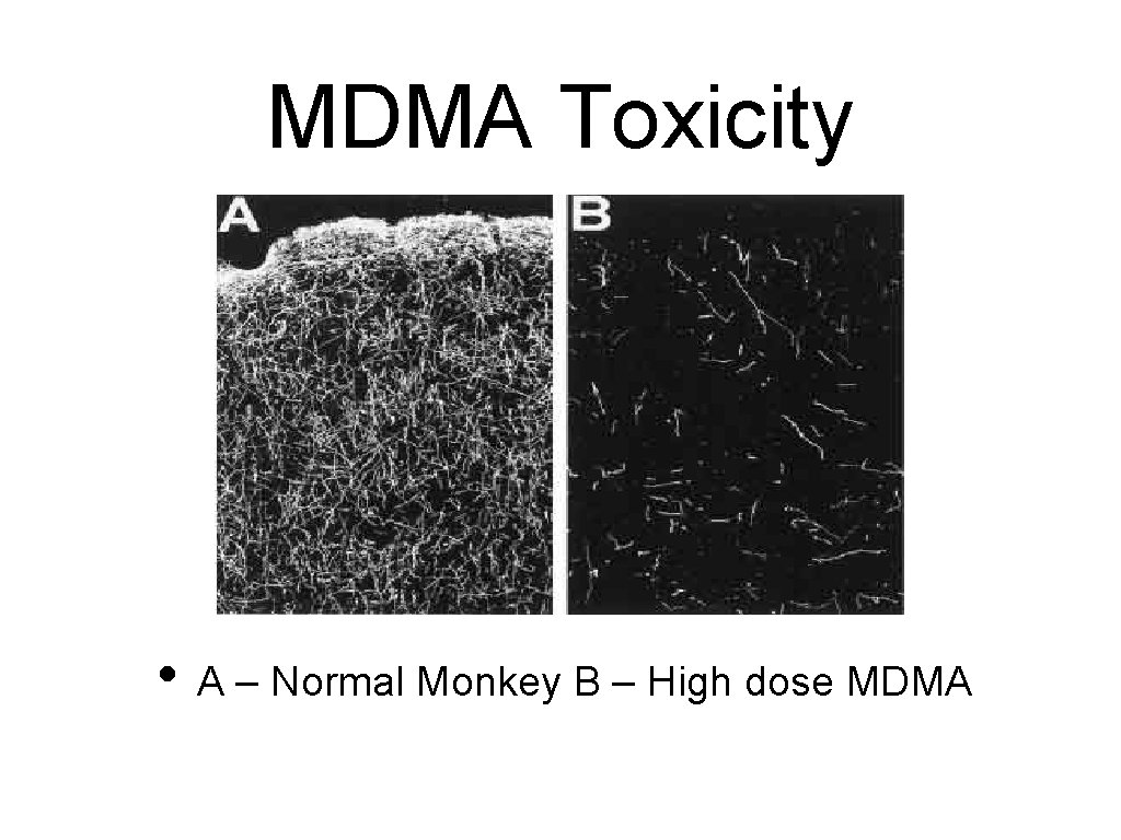 MDMA Toxicity • A – Normal Monkey B – High dose MDMA 