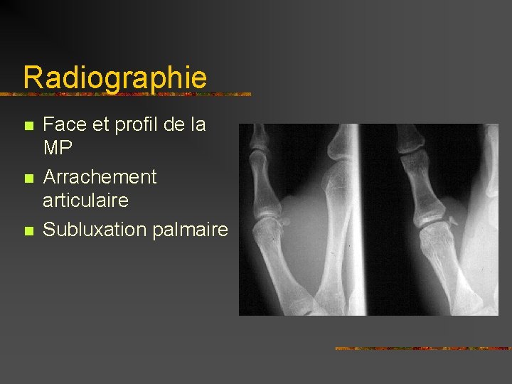 Radiographie n n n Face et profil de la MP Arrachement articulaire Subluxation palmaire