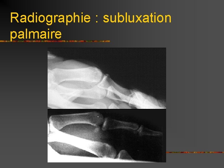 Radiographie : subluxation palmaire 