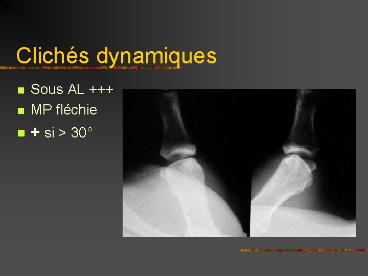 Clichés dynamiques n Sous AL +++ MP fléchie n + si > 30° n