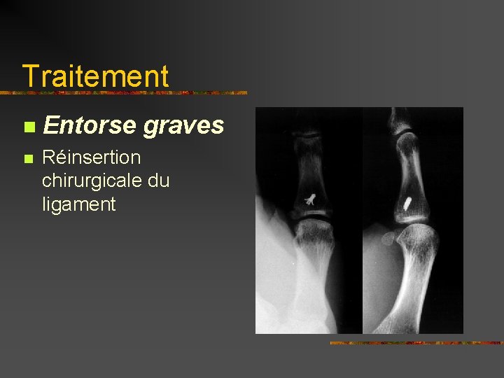 Traitement n Entorse graves n Réinsertion chirurgicale du ligament 