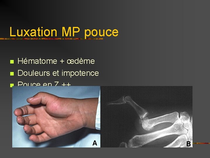 Luxation MP pouce n n n Hématome + œdème Douleurs et impotence Pouce en