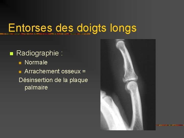 Entorses doigts longs n Radiographie : Normale n Arrachement osseux = Désinsertion de la