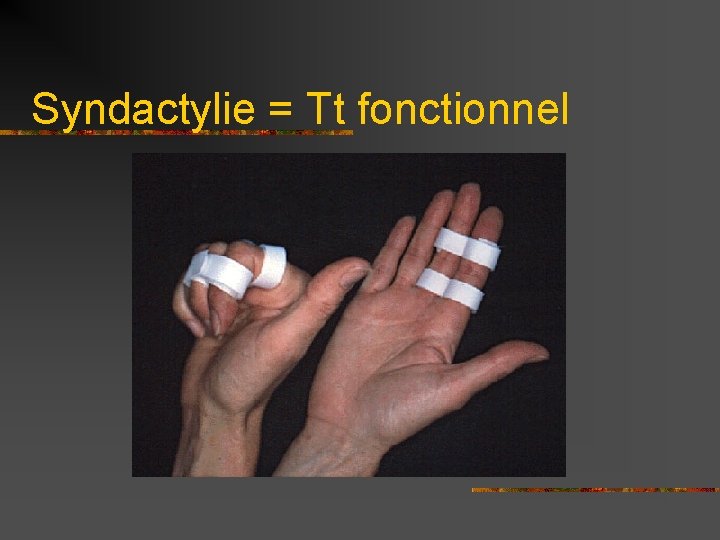 Syndactylie = Tt fonctionnel 