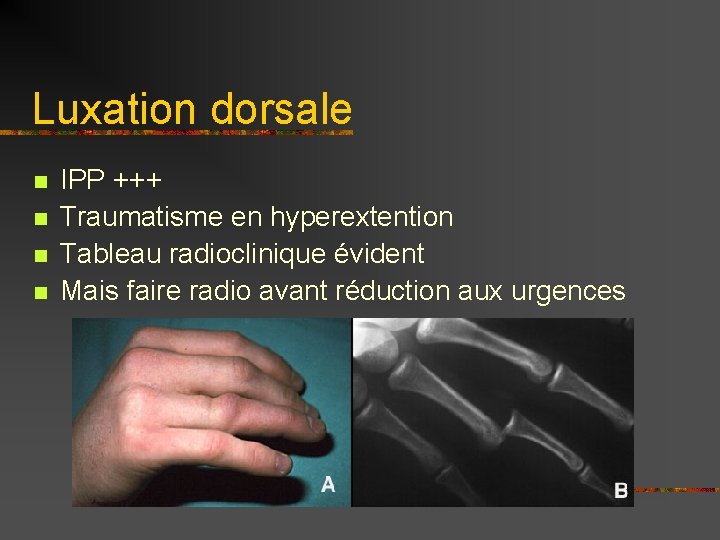 Luxation dorsale n n IPP +++ Traumatisme en hyperextention Tableau radioclinique évident Mais faire