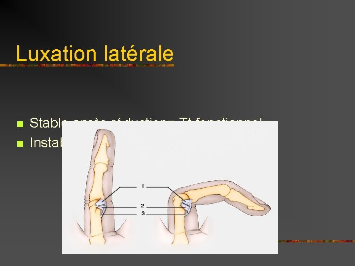 Luxation latérale n n Stable après réduction= Tt fonctionnel Instable = Tt chirurgical 