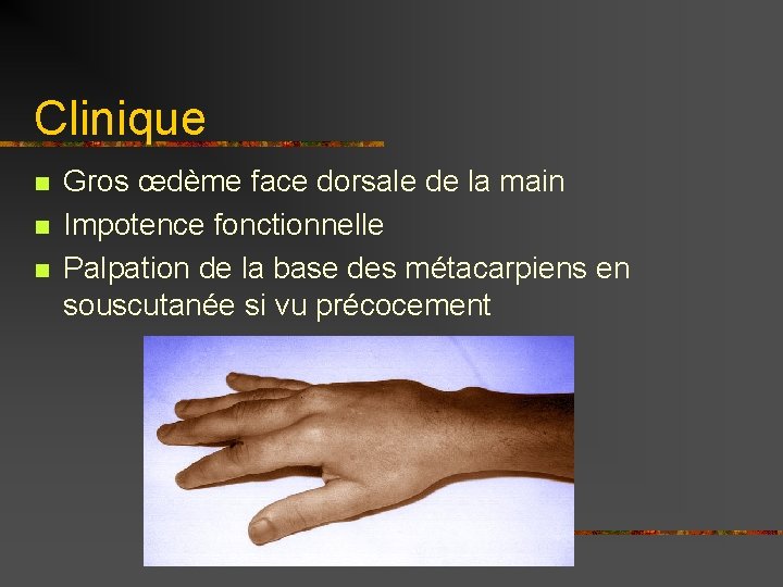 Clinique n n n Gros œdème face dorsale de la main Impotence fonctionnelle Palpation