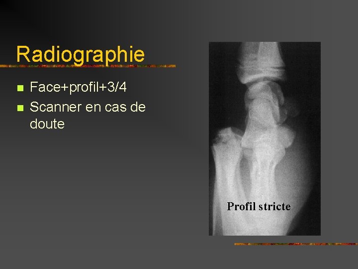 Radiographie n n Face+profil+3/4 Scanner en cas de doute Profil stricte 