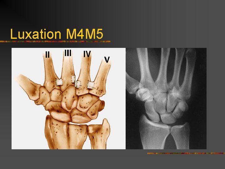 Luxation M 4 M 5 