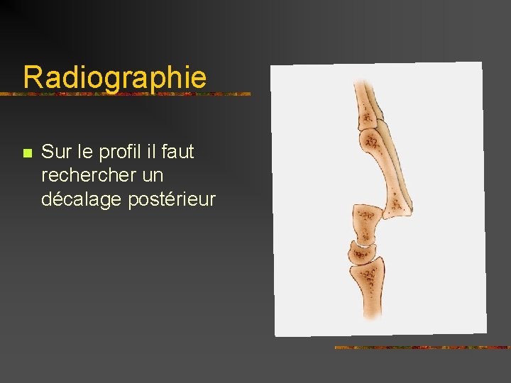 Radiographie n Sur le profil il faut recher un décalage postérieur 