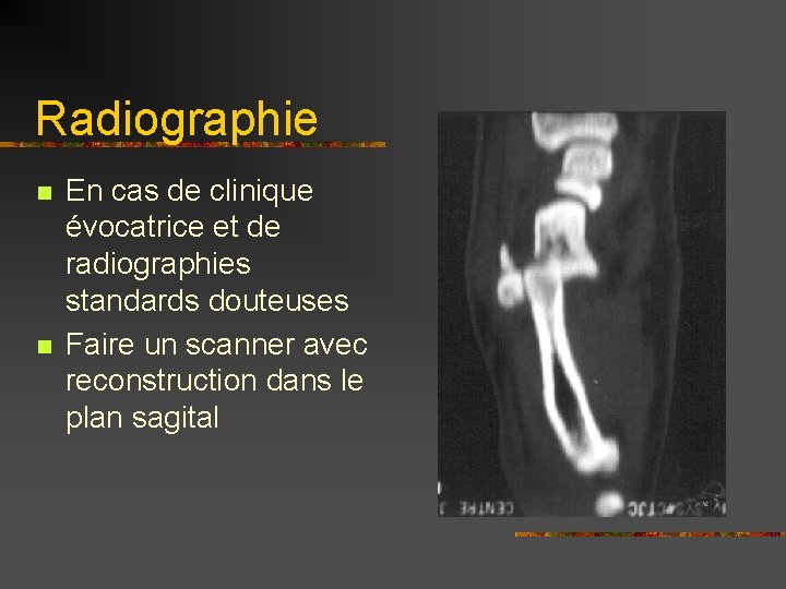 Radiographie n n En cas de clinique évocatrice et de radiographies standards douteuses Faire