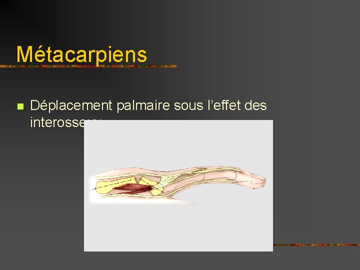 Métacarpiens n Déplacement palmaire sous l’effet des interosseux 