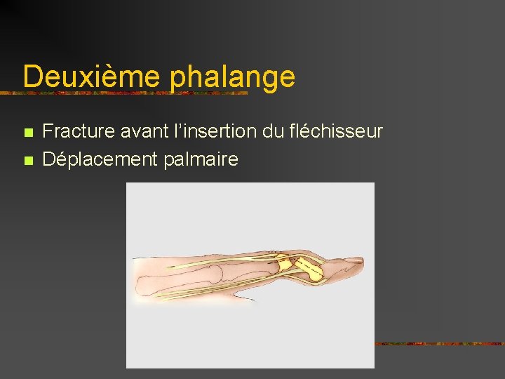 Deuxième phalange n n Fracture avant l’insertion du fléchisseur Déplacement palmaire 