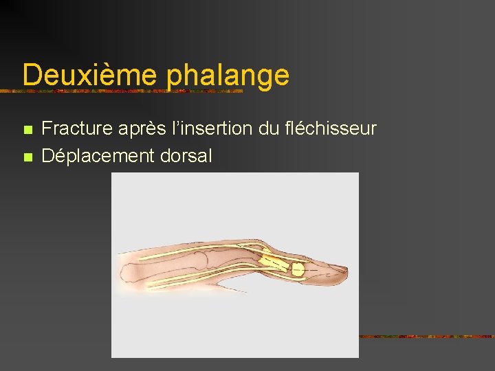 Deuxième phalange n n Fracture après l’insertion du fléchisseur Déplacement dorsal 
