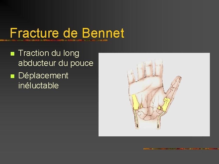 Fracture de Bennet n n Traction du long abducteur du pouce Déplacement inéluctable 