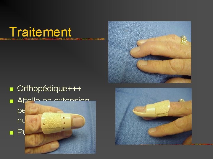 Traitement n n n Orthopédique+++ Attelle en extension pendant 6 semaines nuit et jour