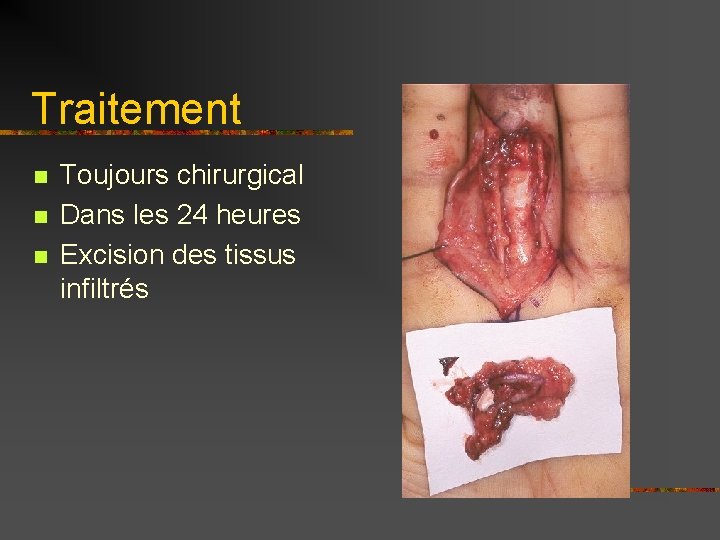 Traitement n n n Toujours chirurgical Dans les 24 heures Excision des tissus infiltrés