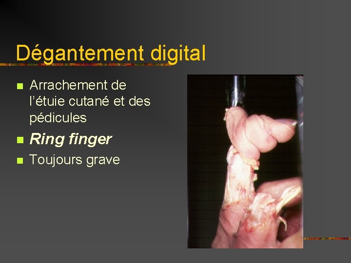 Dégantement digital n Arrachement de l’étuie cutané et des pédicules n Ring finger n