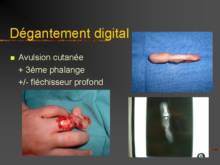 Dégantement digital n Avulsion cutanée + 3ème phalange +/- fléchisseur profond 