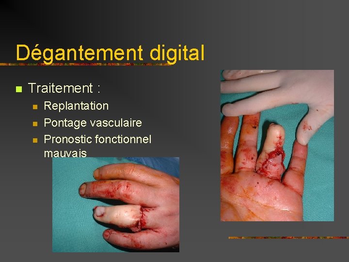 Dégantement digital n Traitement : n n n Replantation Pontage vasculaire Pronostic fonctionnel mauvais