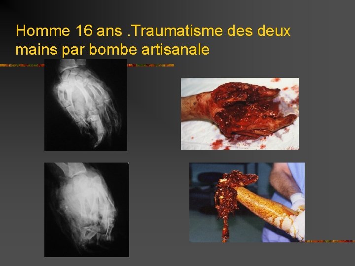 Homme 16 ans. Traumatisme des deux mains par bombe artisanale 