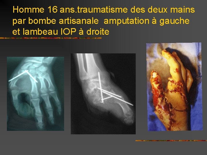 Homme 16 ans. traumatisme des deux mains par bombe artisanale amputation à gauche et