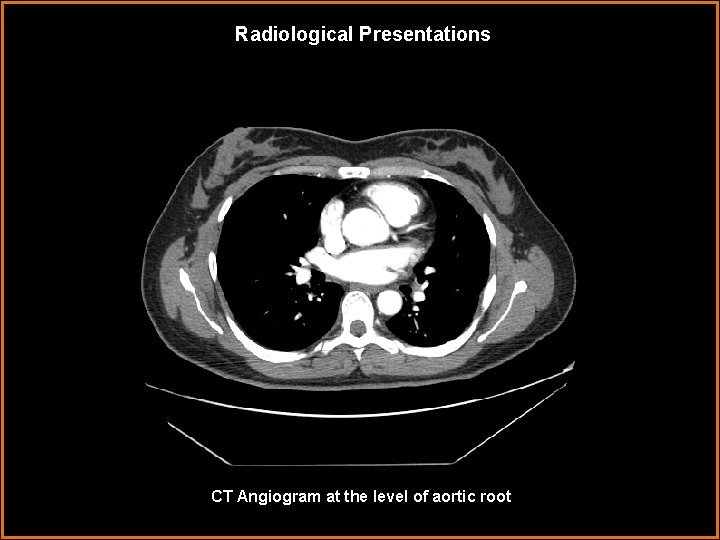Radiological Presentations CT Angiogram at the level of aortic root 