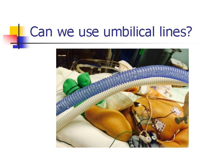 Can we use umbilical lines? 