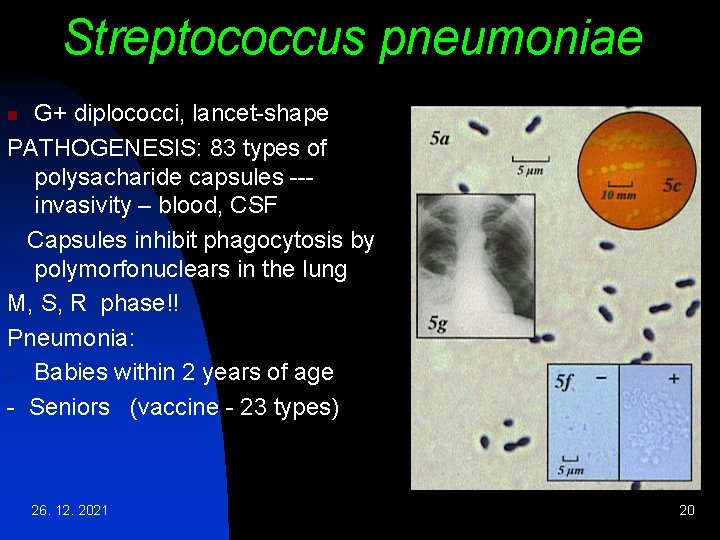 Streptococcus pneumoniae G+ diplococci, lancet-shape PATHOGENESIS: 83 types of polysacharide capsules --invasivity – blood,