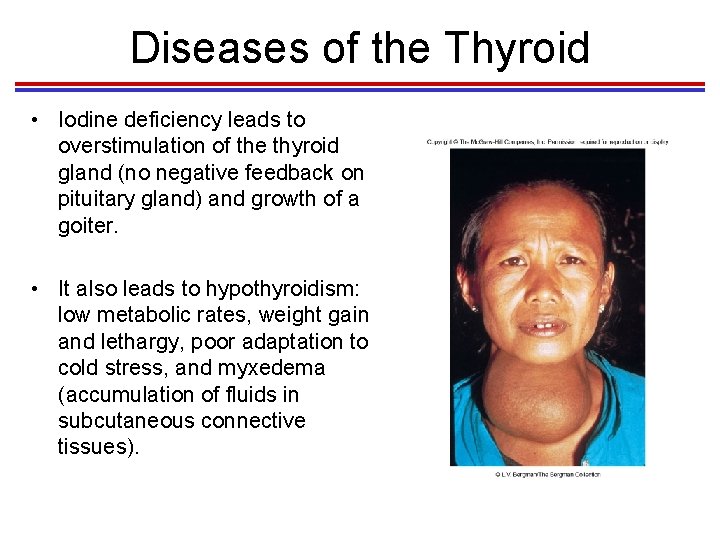 Diseases of the Thyroid • Iodine deficiency leads to overstimulation of the thyroid gland