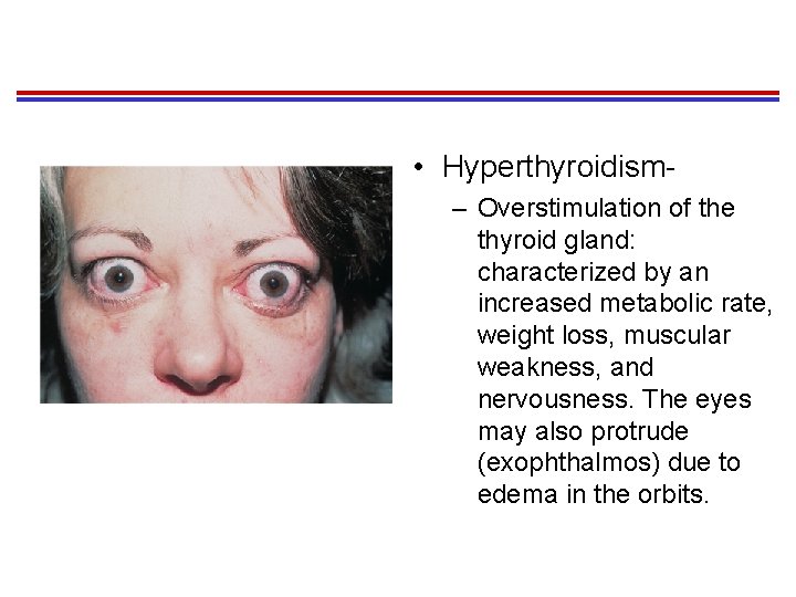  • Hyperthyroidism– Overstimulation of the thyroid gland: characterized by an increased metabolic rate,