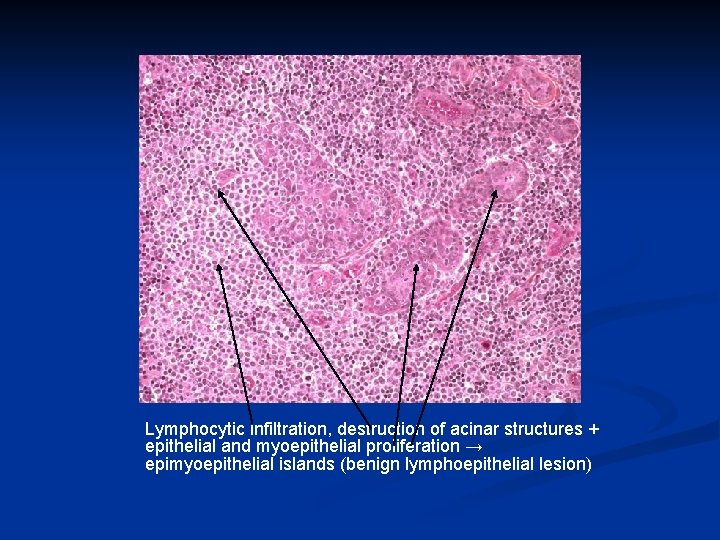 Lymphocytic infiltration, destruction of acinar structures + epithelial and myoepithelial proliferation → epimyoepithelial islands Lymphocytic infiltration, destruction of acinar structures + epithelial and myoepithelial proliferation → epimyoepithelial islands