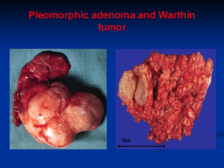Pleomorphic adenoma and Warthin tumor Pleomorphic adenoma and Warthin tumor