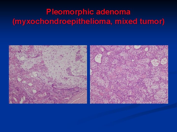 Pleomorphic adenoma (myxochondroepithelioma, mixed tumor) Pleomorphic adenoma (myxochondroepithelioma, mixed tumor)