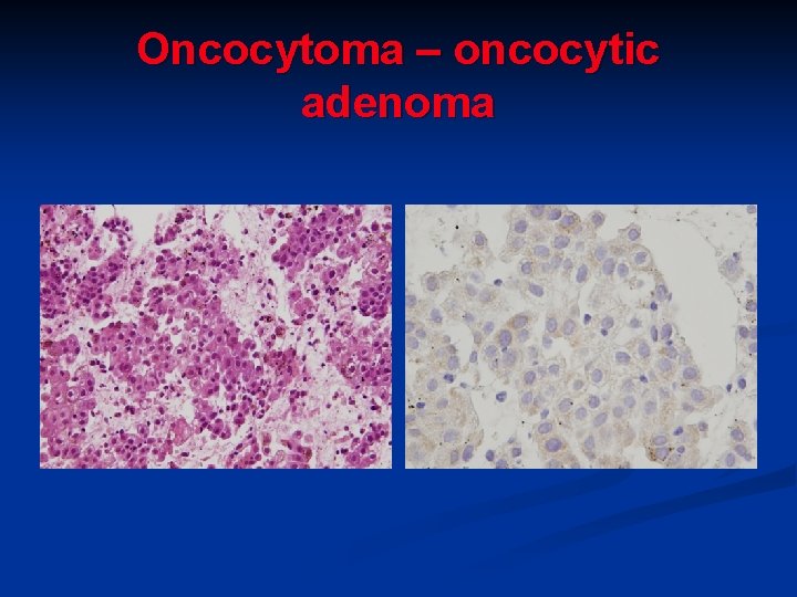Oncocytoma – oncocytic adenoma Oncocytoma – oncocytic adenoma