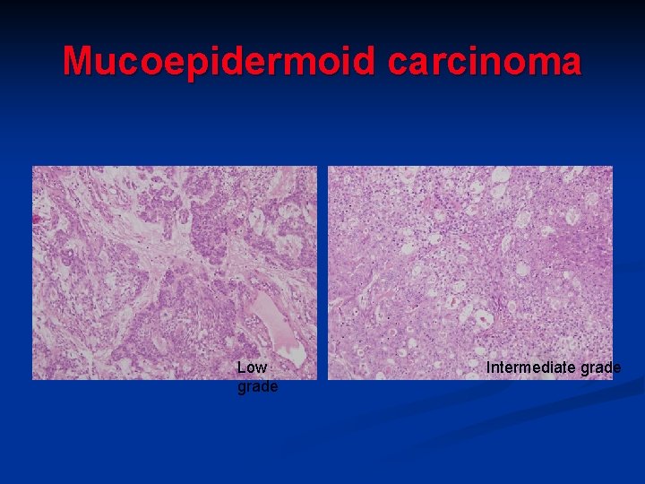 Mucoepidermoid carcinoma Low grade Intermediate grade Mucoepidermoid carcinoma Low grade Intermediate grade