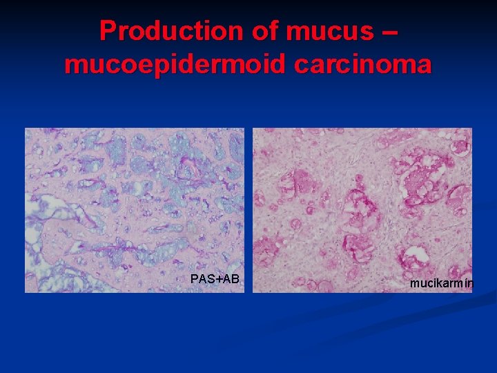 Production of mucus – mucoepidermoid carcinoma PAS+AB mucikarmín Production of mucus – mucoepidermoid carcinoma PAS+AB mucikarmín