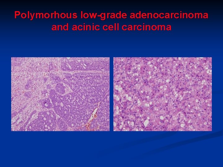 Polymorhous low-grade adenocarcinoma and acinic cell carcinoma Polymorhous low-grade adenocarcinoma and acinic cell carcinoma