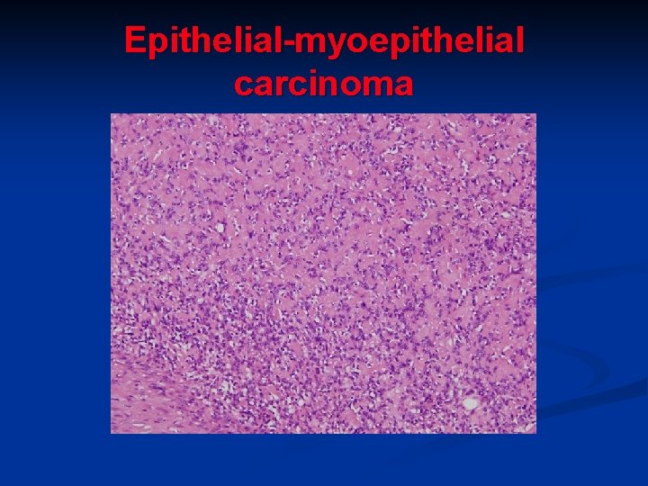 Epithelial-myoepithelial carcinoma Epithelial-myoepithelial carcinoma