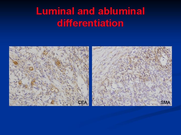 Luminal and abluminal differentiation CEA SMA Luminal and abluminal differentiation CEA SMA
